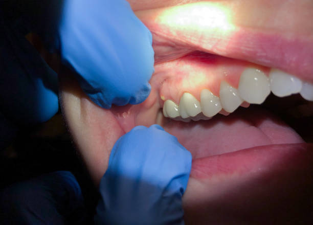 Best Chipped Tooth Repair Near Me  in Johnston, IA